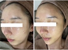 ホワイトアクア 岐阜店(WHITE AQUA)/ハーブピーリング/岐阜/ニキビ