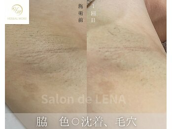 サロンドレナ 名駅店/ハーブピーリング サロンドレナ