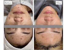 エアリアル 大牟田店/ニキビケアはエステで改善！