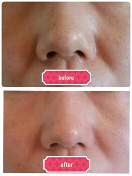 エッセンシャル 南海難波店(ESSENTIAL)/【REVI】ハーブピーリング