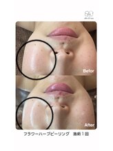 サロンドビジュー(salon de bijou)/ハーブピーリング×ニキビ