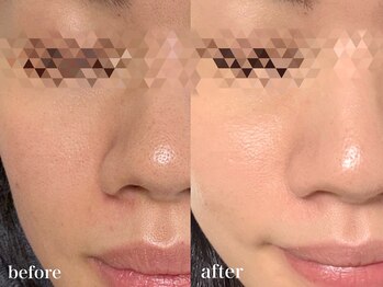 リアルナ(REALUNA)/毛穴/赤みの改善