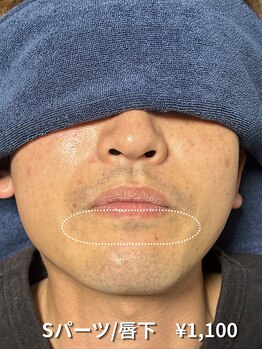 カナウ(KANAU)/【Sパーツ/脱毛】唇下