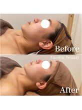 モット 神戸店(Motto)/フェイシャル 小顔矯正