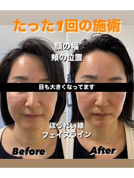 モーイエンチャーム(mooi en charme)/小顔フェイシャル×ラジオ波