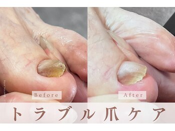 アルヴィス(Arviss)/トラブル爪ケア