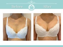 美人バスト 渋谷店/【バストアップ・育乳】症例☆