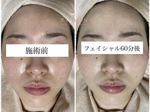 トータルビューティサロン ルボン(RUBON)/フェイシャルエステビフォーアフ