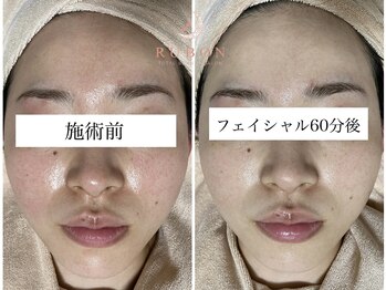 トータルビューティサロン ルボン(RUBON)/フェイシャルエステビフォーアフ