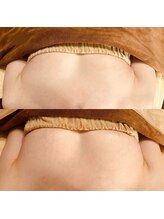 ベルージュ(Bellege)/ボンボンバストBefore after