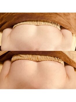 ベルージュ(Bellege)/ボンボンバストBefore after