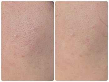 ローマサロン/白玉スノーピールトリートメント