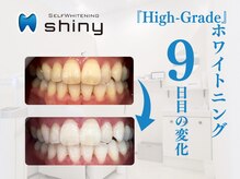 ホワイトニングサロン シャイニー 浜松細島店(shiny)/【超絶・美・白】ホワイトニング