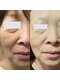 ナチュラ ソース(NatureSouce)の写真/毛穴洗浄でクリアな肌へ！表情筋を刺激し、フェイスラインまでリフトケア◎たるみケアで若々しい印象へ☆