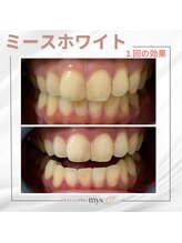 ミースホワイトニング(mys whitening)/ビフォーアフター【歯科提携】