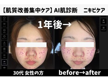 サロンスペース/30代女性 AI肌診断 1年後