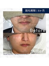 メンズクリア フィール 旭川店/【メンズクリア】お客様の施術例