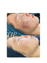 ソリッジ肌管理室/ニキビケア