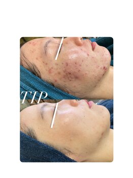 ソリッジ肌管理室/ニキビケア