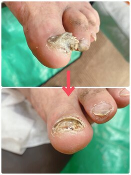 一宮巻き爪センター/肥厚爪