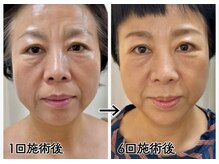 ルビーミー(Ruby's Me)の雰囲気（テラボーラー２週間に１度のペース、３ヶ月後の変化☆）