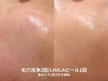 ピブ(pib.)/毛穴洗浄は侮れない！！