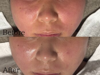 ルミライズ(lumirise)/〈２回目での効果〉