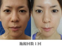 パルファンカルム 駅西本町店/つるんとなめらかなお肌へ！