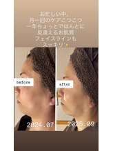 ジュネラ ボーテ(Jenela beaute)/ツヤハリライン変化