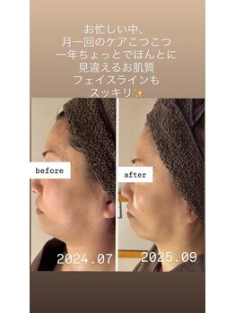 ジュネラ ボーテ(Jenela beaute)/ツヤハリライン変化