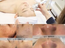 アール アンド ビューティーサロン(Ｒ＆ BeautySalon)の雰囲気（人気NO1☆最先端「毛穴洗浄×幹細胞導入」効果に驚きの声続出！）