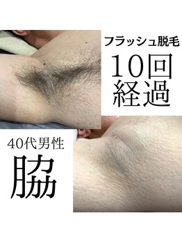 アンジェリーナ/痛みを抑えたフラッシュ脱毛