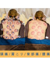 いつつのき/カッピング（吸い玉）