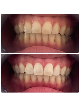 ユーラボ 表参道(YOU-LAB)/Befor/After【ホワイトニング】