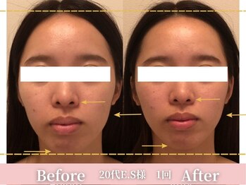 アメリイ 百合ヶ丘 新百合ヶ丘(Amerii)/小顔1回30代リフトアップ