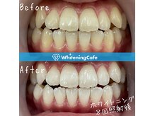 最短で効果実感♪差し歯や詰め物があってもホワイトニング可能！