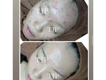 ネムレル森(Nemureru森)/TIPハーブピーリング(5回目)