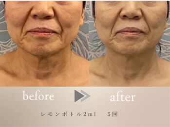 グロッシー(glossy)/【症例】プラズマ60代