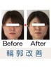 【エラ張り・歪み・左右差に】1回で実感☆ 輪郭改善コース