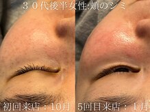 ブリエ(Briller)/シミ改善