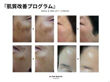サロンソワ(salon Soi.)/ピュールボーテ：肌質改善