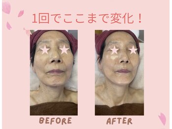セレーナ(Serena)の写真/【40代からのたるみ改善】フェイスライン引き上げ｜小顔×ハリ肌へ