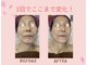 セレーナ(Serena)の写真/【40代からのたるみ改善】フェイスライン引き上げ｜小顔×ハリ肌へ