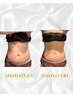 【人気No.1】たるみお腹改善～アイスナイフ～　￥11,000→￥8,800