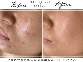 アリュール 倉敷(ALLURE)の写真/【人気No.1の肌質改善メニュー】肌に優しい濃厚ハーブで素肌の内側から改善◎化粧ノリ＆浸透率も抜群♪
