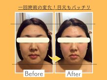 ウェルビープラーカ(Well-beプラーカ)/フェイスラインもスッキリ