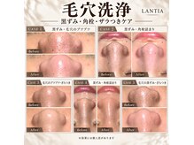 ランティア 大阪梅田南森町(LANTIA)の雰囲気（通いやすい価格設定♪毛穴洗浄は2,200円から。/毛穴洗浄/毛穴）