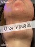 【学割U24】24歳以下限定オーヴル毛穴フェイシャル！13200→2999円