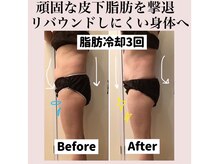 リラ(RILA)の雰囲気（脂肪冷却痩身before after運動・食事制限がツライ方におすすめ!）