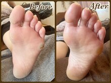 ビューティースパ(Beauty-Spa)/【タコ・ウオノメの角質除去】